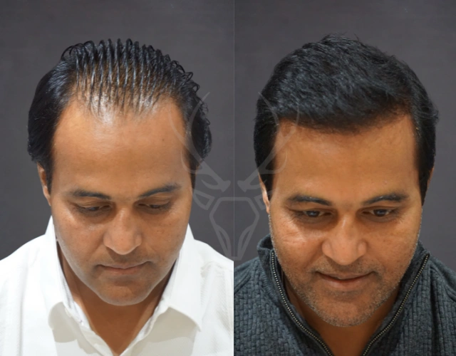 Musk Clinic Hair Transplant Results - Before After Results 28