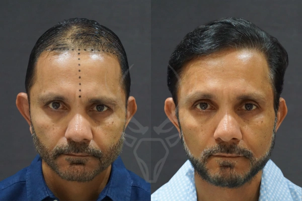 Musk Clinic Hair Transplant Results - Before After Results 29 Centre