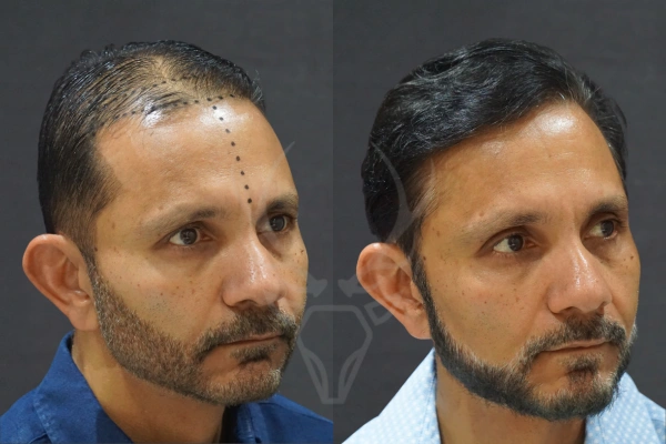 Musk Clinic Hair Transplant Results - Before After Results 29 Left
