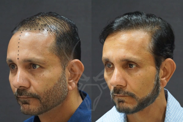 Musk Clinic Hair Transplant Results - Before After Results 29 Right