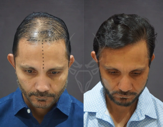 Musk Clinic Hair Transplant Results - Before After Results 29