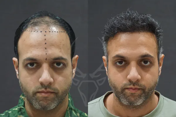 Musk Clinic Hair Transplant Results - Before After Results 30 Centre