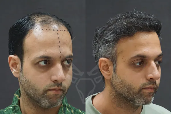Musk Clinic Hair Transplant Results - Before After Results 30 Left