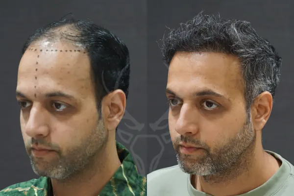 Musk Clinic Hair Transplant Results - Before After Results 30 Right