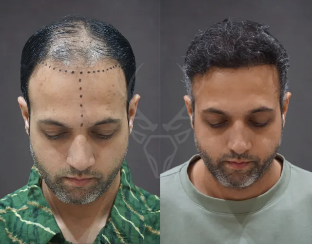 Musk Clinic Hair Transplant Results - Before After Results 30