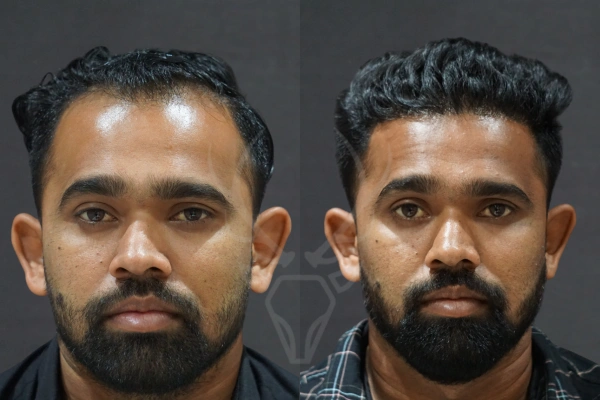 Musk Clinic Hair Transplant Results - Before After Results 31 Cenre