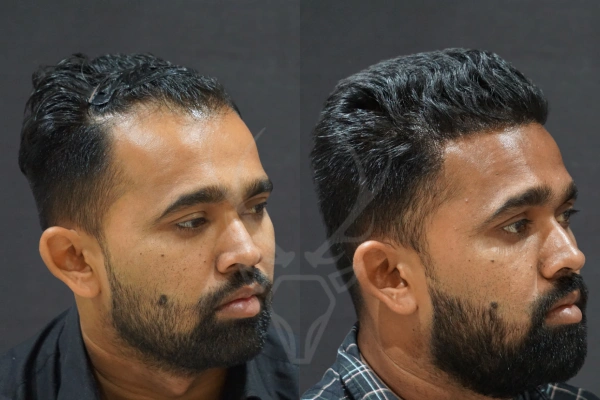 Musk Clinic Hair Transplant Results - Before After Results 31 Left