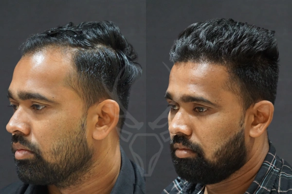 Musk Clinic Hair Transplant Results - Before After Results 31 Right