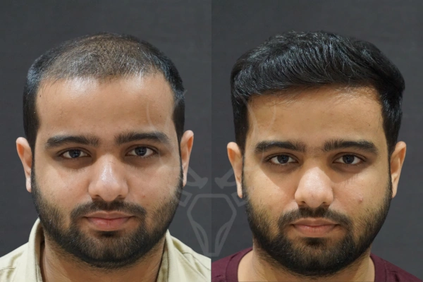 Musk Clinic Hair Transplant Results - Before After Results 32 Centre