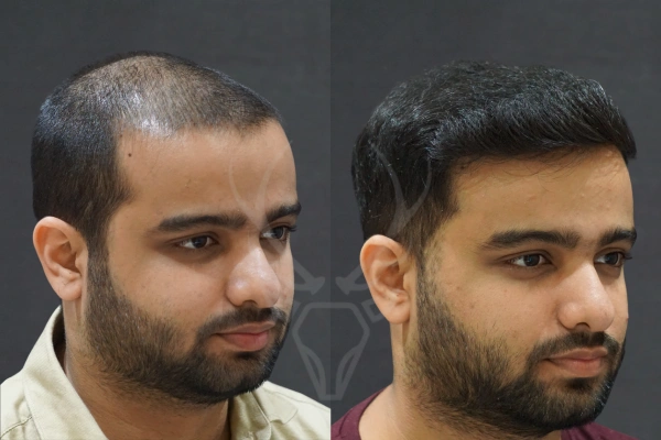 Musk Clinic Hair Transplant Results - Before After Results 32 Left