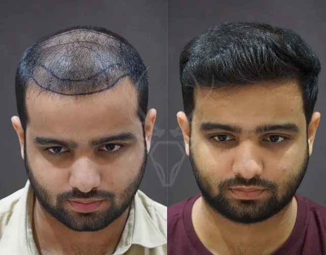 Musk Clinic Hair Transplant Results - Before After Results 32 New