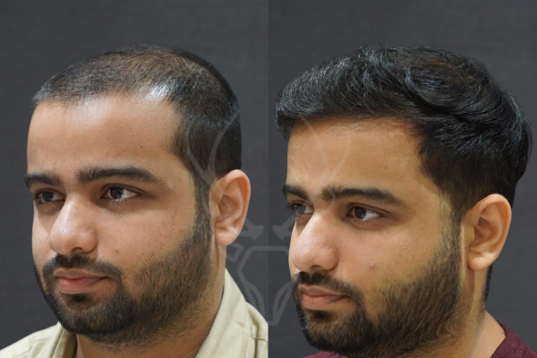 Musk Clinic Hair Transplant Results - Before After Results 32 Right