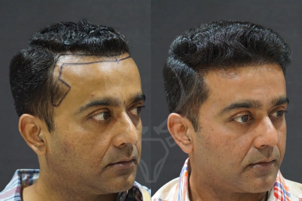 Musk Clinic Hair Transplant Results - Before After Results 33 Left