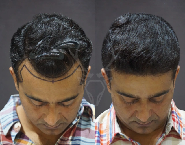 Top Hair Transplant Cost in Indore | Musk Clinic