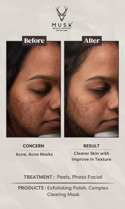 Banshi (Peels, Photo Facial) Skin Treatment Before After Results