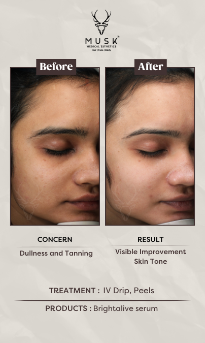 Chandni (IV Drip, Peels) Skin Treatment Before After Results