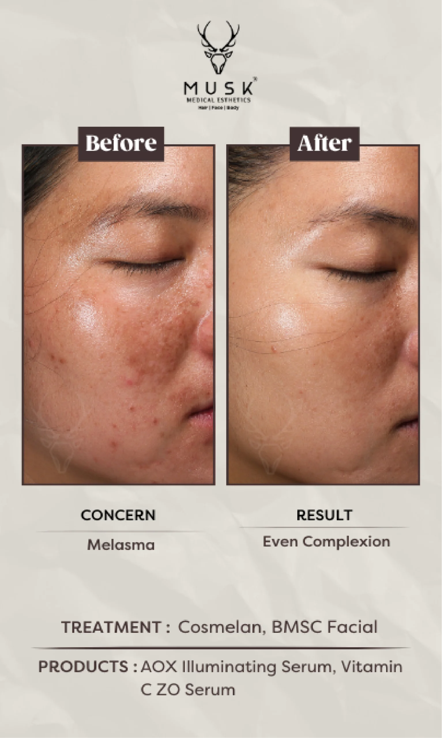 Elunge (Cosmelan, BMSC Facial) Skin Treatment Before After Results