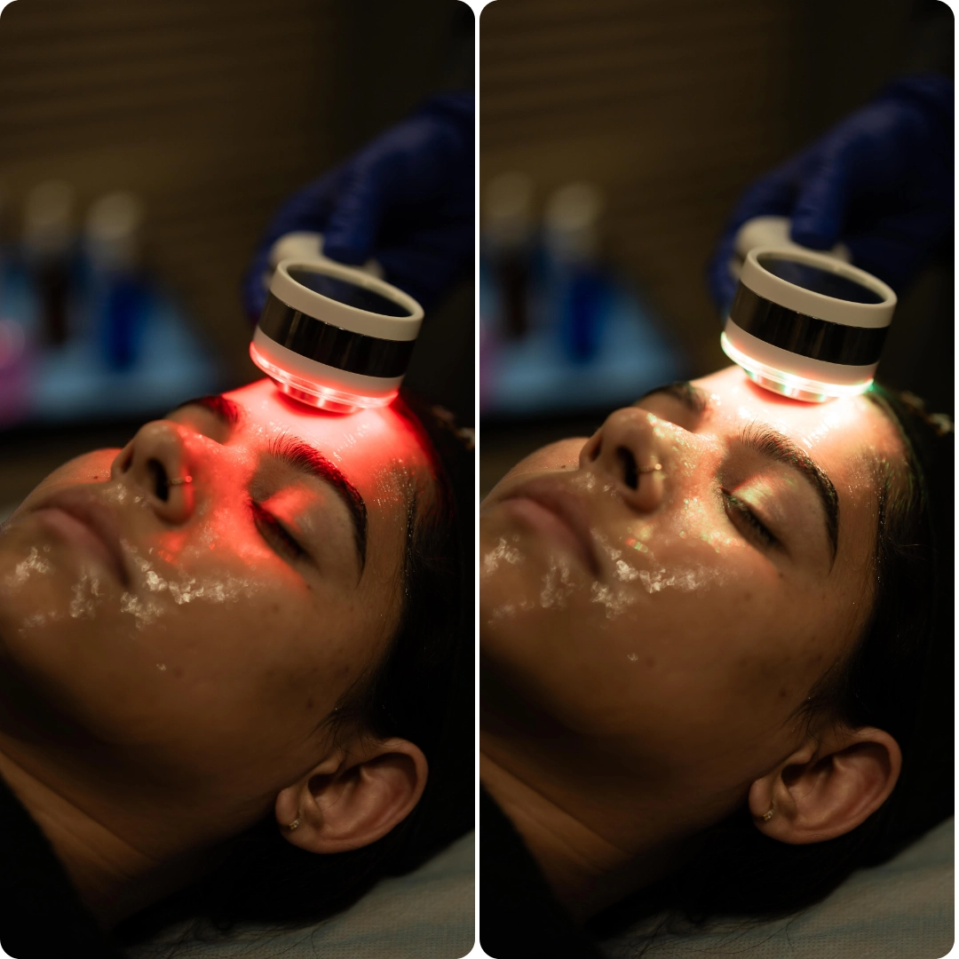 Fire and Ice Facial Treatment (1)
