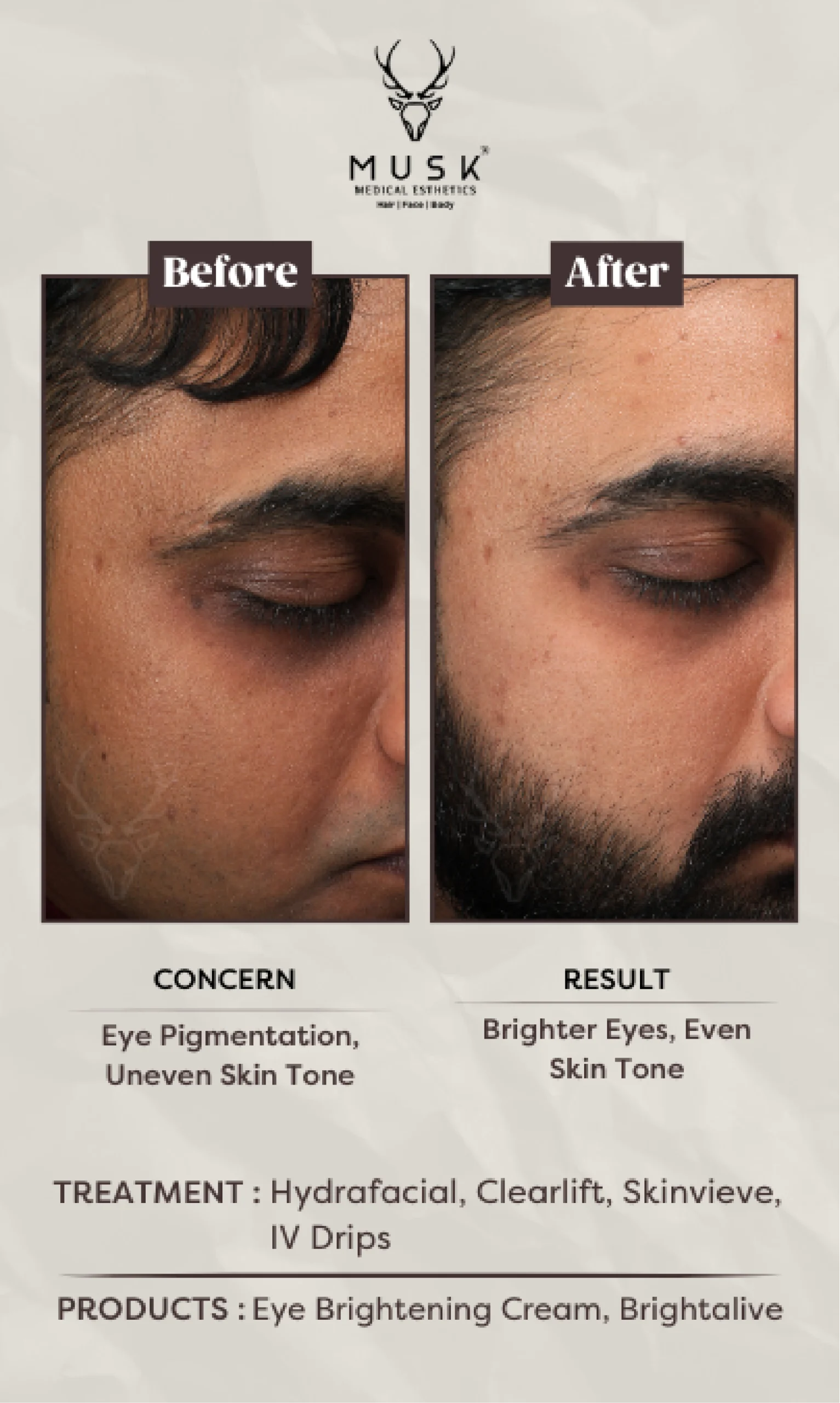 Ishan Nayak (Hydrafacial, Clearlift, Skinvieve, IV drips) Skin Treatment Before After Results