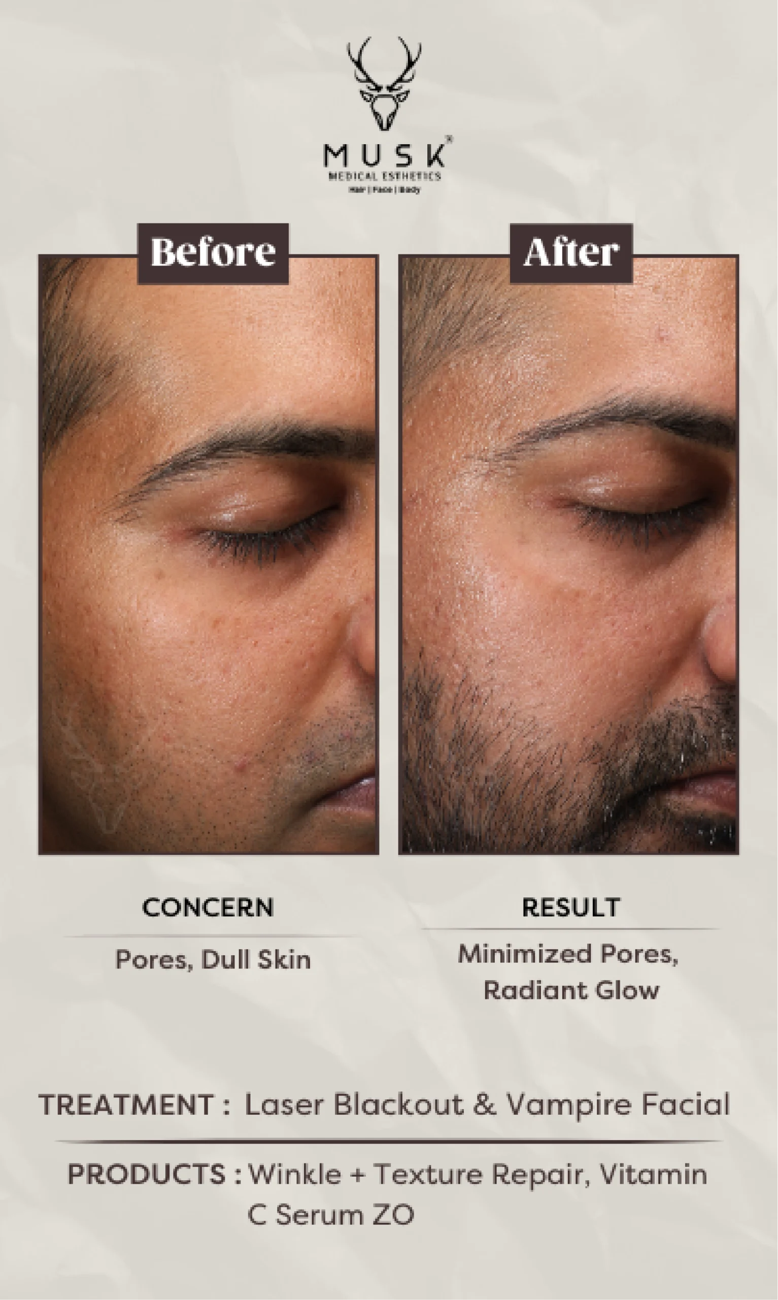 Jatin Bhatt (Laser blackout, Vampire Facial) Skin Treatment Before After Results
