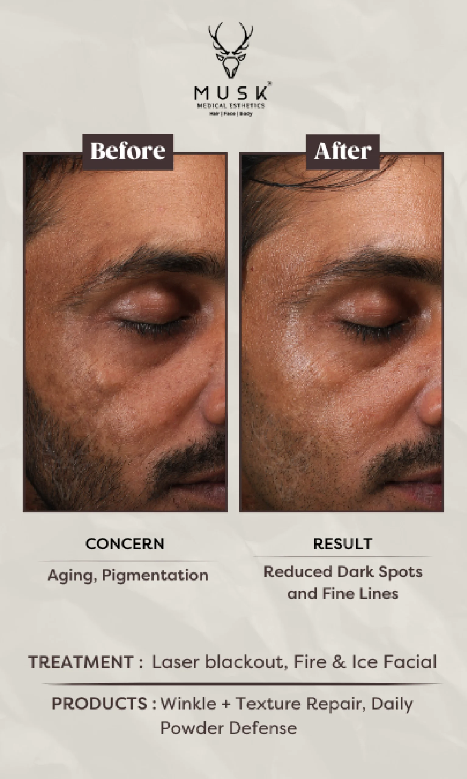 Naresh (Laser blackout, Fire&Ice Facial) Skin Treatment Before After Results