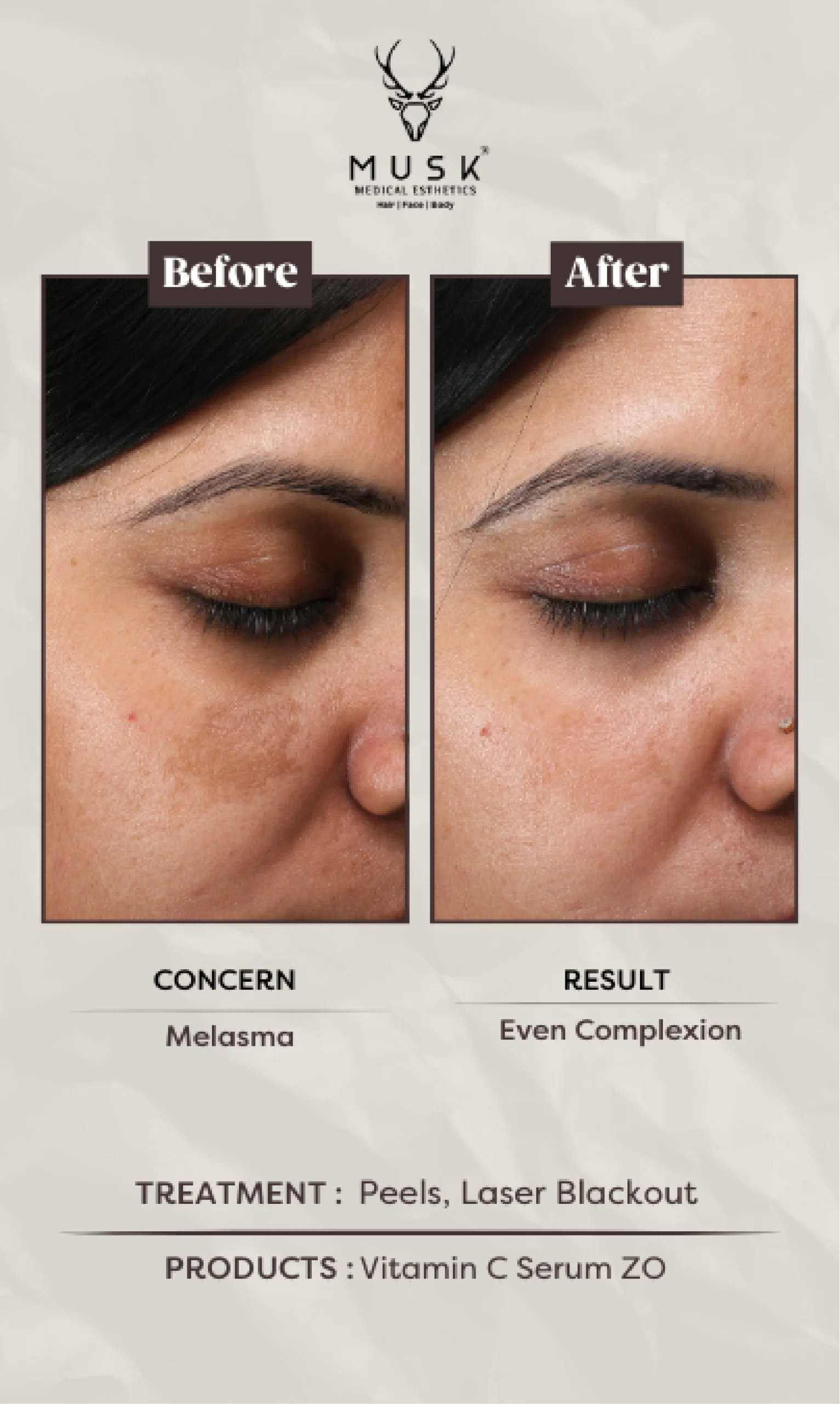 Richa (Peels, Laser blackout) Skin Treatment Before After Results