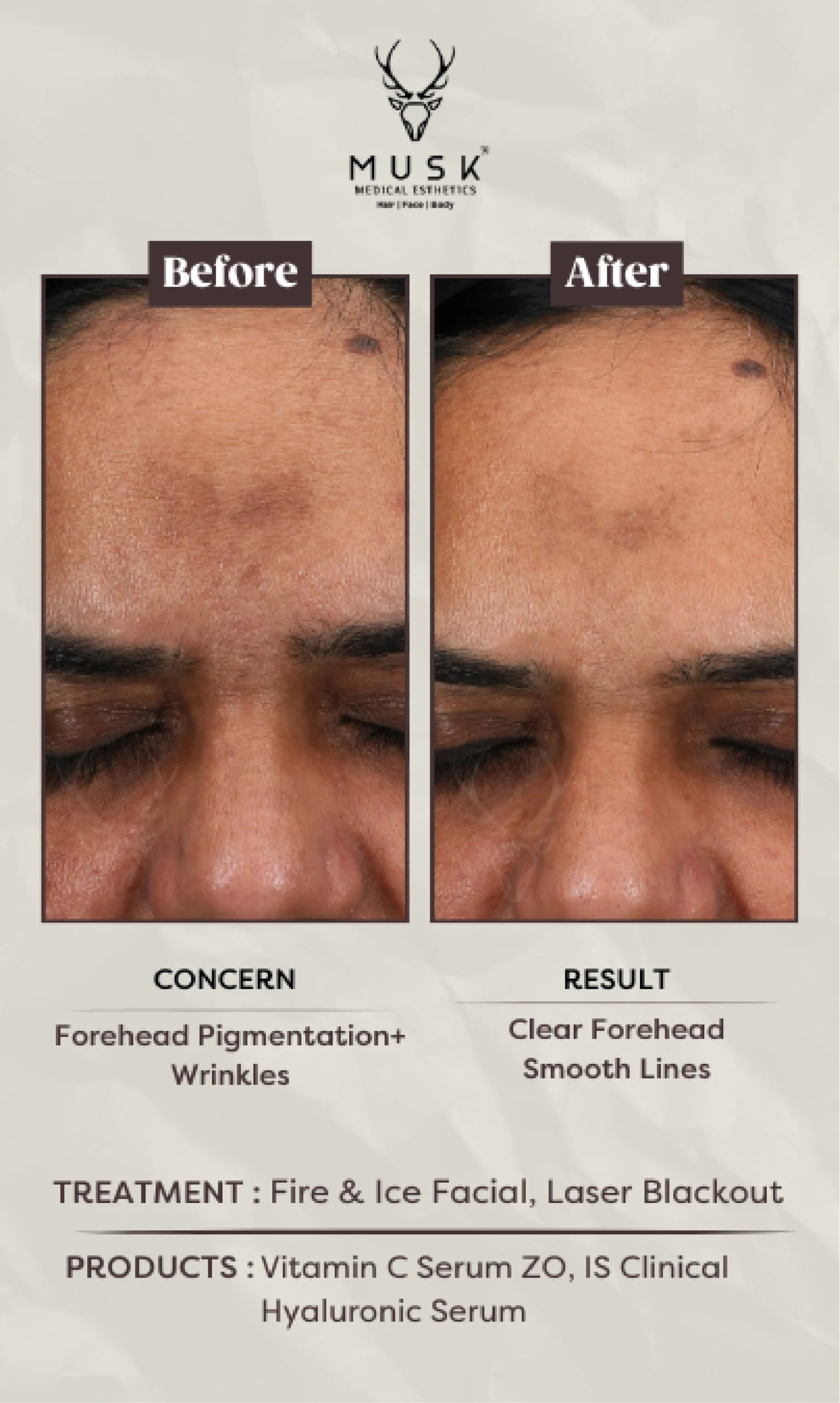 Sabra (Fire& Ice facial, Laser blackout) Skin Treatment Before After Results
