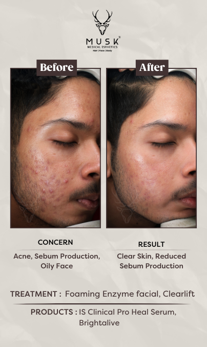 Sahil Patel (Foaming Enzyme Facial, Clearlift) Skin Treatment Before After Results