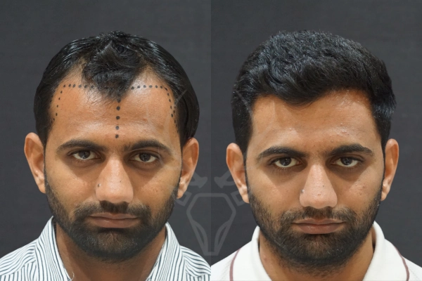 Musk Clinic Hair Transplant Results Before After Results 34 (Center)