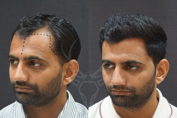 Musk Clinic Hair Transplant Results Before After Results 34 (Left)