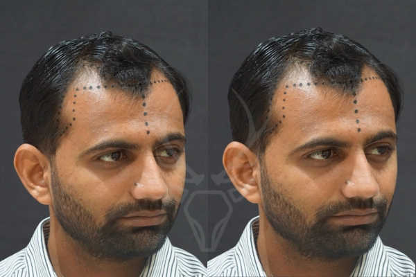 Musk Clinic Hair Transplant Results Before After Results 34 (Right)