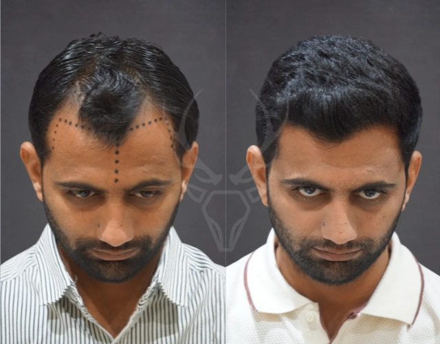 Musk Clinic Hair Transplant Results Before After Results 34
