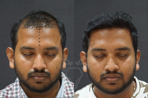 Musk Clinic Hair Transplant Results Before After Results 35 (Center)