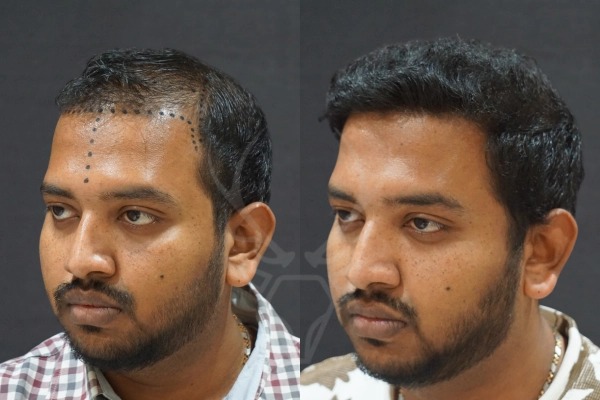 Musk Clinic Hair Transplant Results Before After Results 35 (Left)