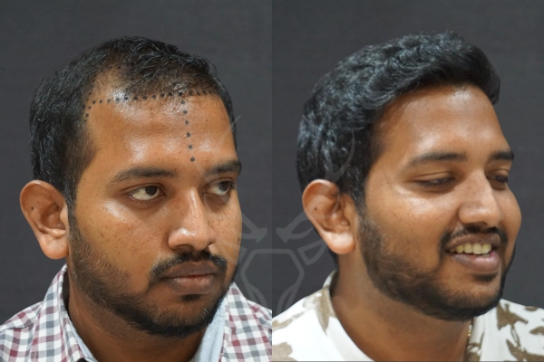 Musk Clinic Hair Transplant Results Before After Results 35 (Right)