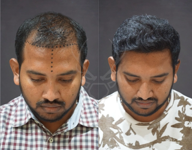 Musk Clinic Hair Transplant Results Before After Results 35