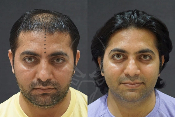 Musk Clinic Hair Transplant Results Before After Results 36 (Center)