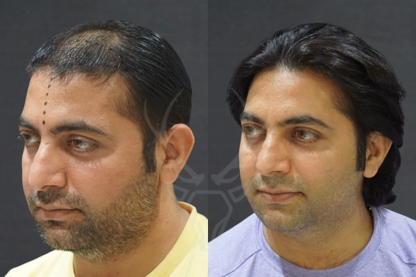Musk Clinic Hair Transplant Results Before After Results 36 (Left)