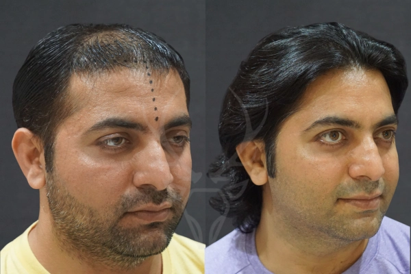Musk Clinic Hair Transplant Results Before After Results 36 (Right)