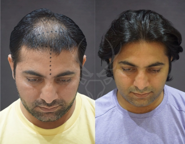 Musk Clinic Hair Transplant Results Before After Results 36