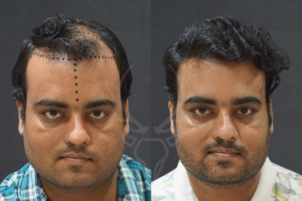 Musk Clinic Hair Transplant Results Before After Results 37 (Center)