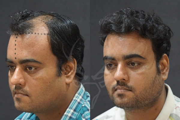 Musk Clinic Hair Transplant Results Before After Results 37 (Left)