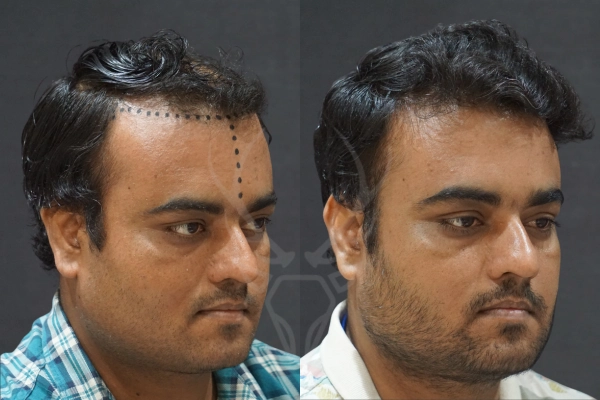 Musk Clinic Hair Transplant Results Before After Results 37 (Right)