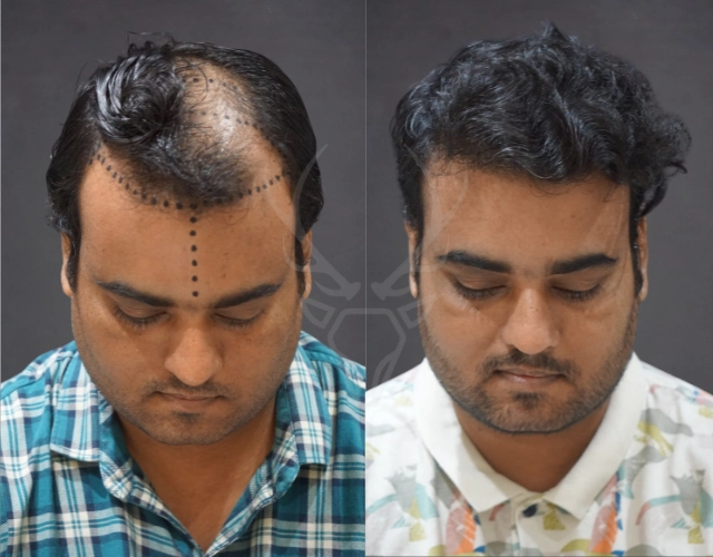 Musk Clinic Hair Transplant Results Before After Results 37