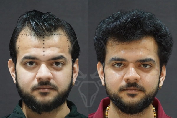 Musk Clinic Hair Transplant Results Before After Results 38 (Center)