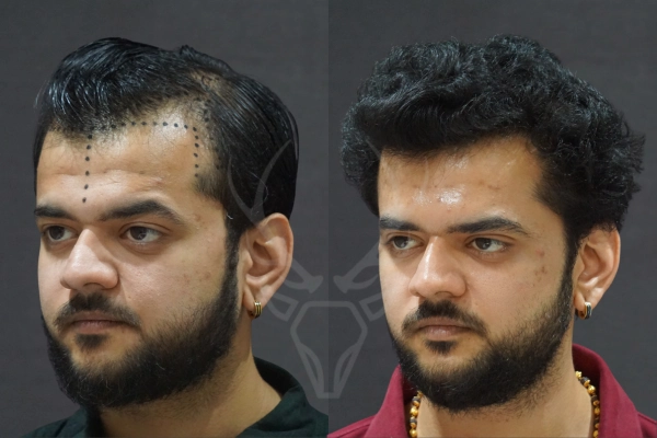 Musk Clinic Hair Transplant Results Before After Results 38 (Left)