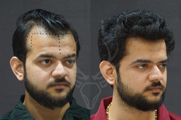 Musk Clinic Hair Transplant Results Before After Results 38 (Right)