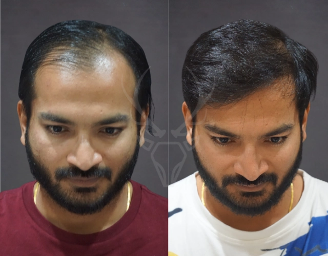 Musk Clinic Hair Transplant Results Before After Results 41