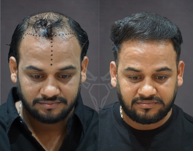 Musk Clinic Hair Transplant Results Before After Results 42