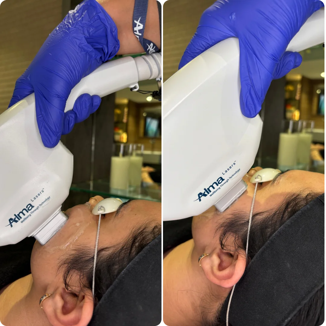 Brighten Your Skin with Musk Radiance Photofacial!